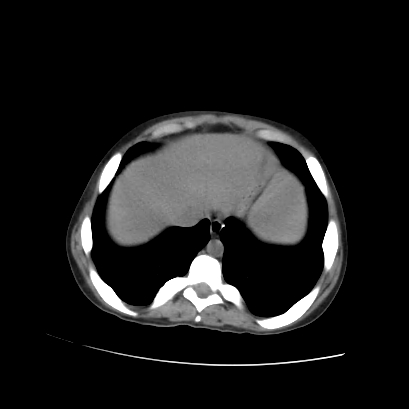 File:Acute calculous cholecystitis in patient with osteopetrosis (Radiopaedia 77871-90159 Axial non-contrast 15).jpg