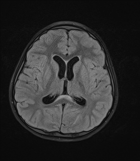 File:Acute cerebellar ataxia (Radiopaedia 61487-69446 Axial FLAIR 12).jpg