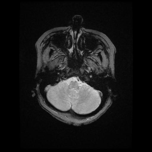 File:Acute cerebral infarct (Radiopaedia 30707-31410 Axial SWI 4).jpg