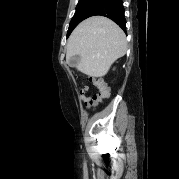 Acute cholecystitis and incidental left sided IVC (Radiopaedia 49352-54459 Sagittal C+ portal venous phase 72).jpg