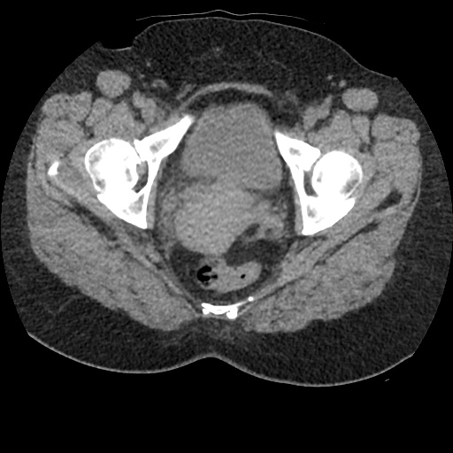Acute cholecystitis and ureteric colic (Radiopaedia 42330-45444 Axial prone 103).jpg