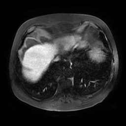 Acute cholecystitis complicated by pylephlebitis (Radiopaedia 65782-74915 Axial arterioportal phase T1 C+ fat sat 6).jpg