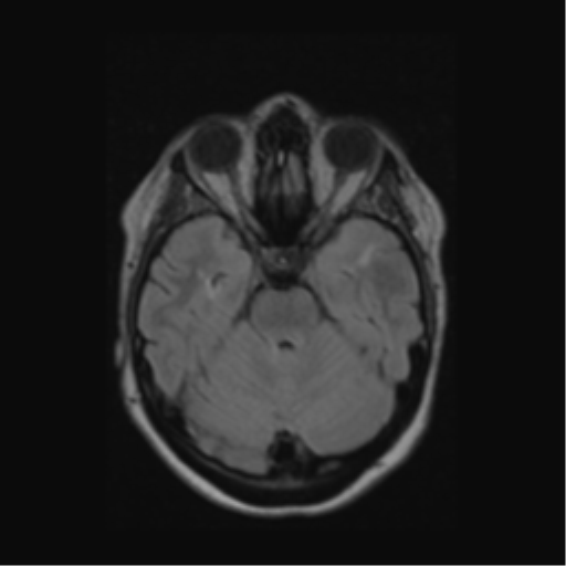 Acute disseminated encephalomyelitis (ADEM) (Radiopaedia 38073-40065 Axial FLAIR 19).png