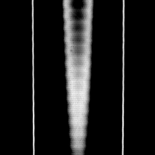 File:Acute diverticulitis - transverse colon (Radiopaedia 87063-103327 Coronal C+ portal venous phase 178).jpg