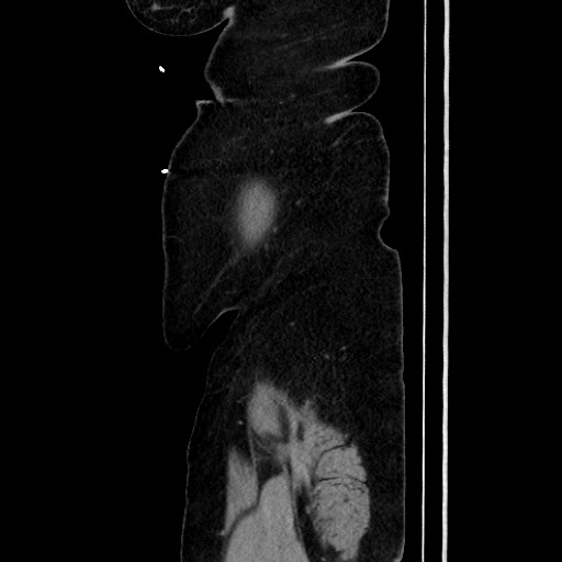 Acute diverticulitis - transverse colon (Radiopaedia 87063-103327 Sagittal C+ portal venous phase 205).jpg