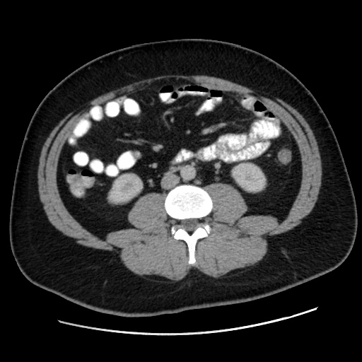 File:Acute diverticulitis with localized perforation (Radiopaedia 41296-44113 Axial C+ portal venous phase 49).jpg