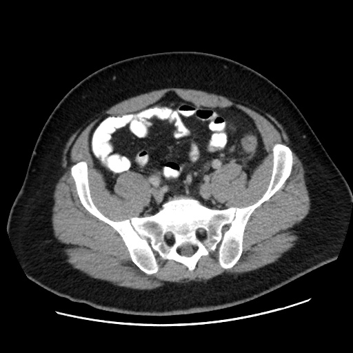 File:Acute diverticulitis with localized perforation (Radiopaedia 41296-44113 Axial C+ portal venous phase 68).jpg