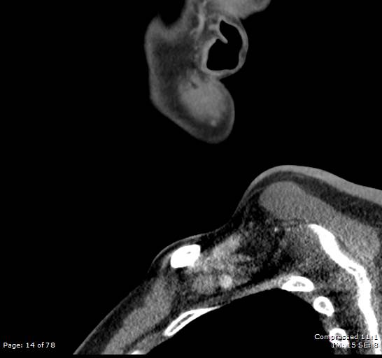 Acute epiglottitis (Radiopaedia 54375-60590 Sagittal C+ arterial phase 14).jpg