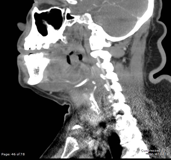 Acute epiglottitis (Radiopaedia 54375-60590 Sagittal C+ arterial phase 46).jpg