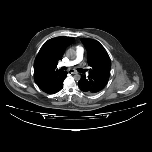 Acute heart failure (CT) (Radiopaedia 79835-93075 Axial C+ arterial phase 10).jpg