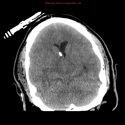 File:Acute hemorrhagic leukoencephalitis (Radiopaedia 14076-72275 Axial non-contrast 16).jpg