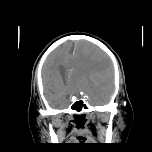 Acute hemorrhagic stroke (Radiopaedia 17507-17223 Coronal non-contrast 22).jpg