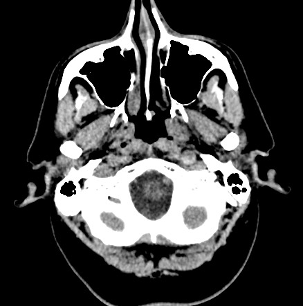 Acute internal carotid artery dissection (Radiopaedia 53541-59558 Axial non-contrast 6).jpg