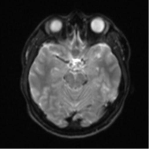 Acute left middle cerebral artery territory infarct with clot retrieval (Radiopaedia 47732-52433 Axial DWI 11).png