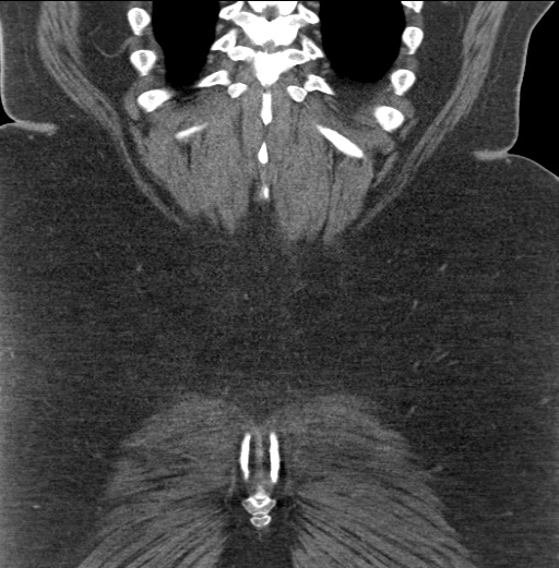 Acute mesenteric venous ischemia (Radiopaedia 46041-50383 Coronal C+ portal venous phase 88).jpg