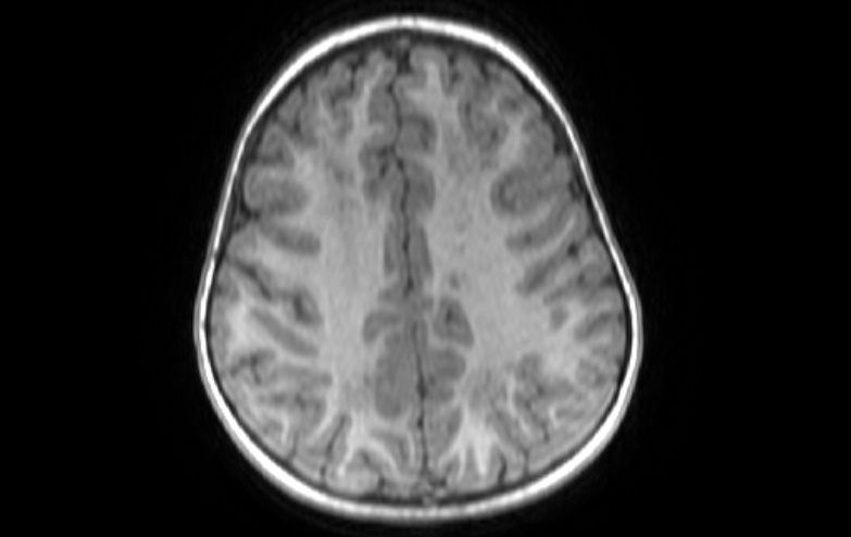 Acute necrotizing encephalitis of childhood (Radiopaedia 67356-76737 Axial T1 27).jpg