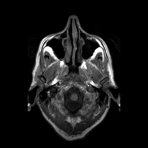 File:Acute necrotizing toxoplasma encephalitis (Radiopaedia 10683-11149 Axial T1 17).jpg