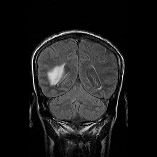 File:Acute necrotizing toxoplasma encephalitis (Radiopaedia 10683-11149 Coronal FLAIR 6).jpg