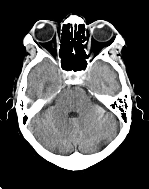 Acute on chronic subdural hematoma (Radiopaedia 74814-85823 Axial non-contrast 35).jpg