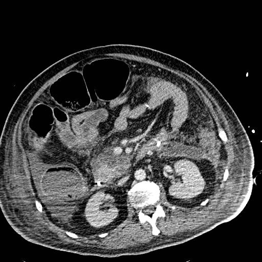 Acute pancreatic necrosis (Radiopaedia 13560-18501 Axial C+ portal venous phase 61).jpg