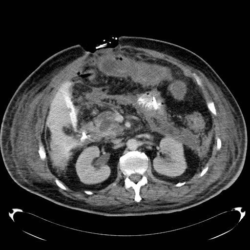 File:Acute pancreatic necrosis (Radiopaedia 13560-18503 Axial C+ portal venous phase 31).jpg