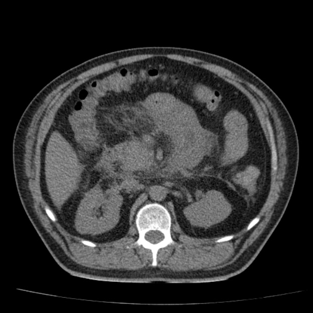 Acute pancreatitis (Radiopaedia 26663-26813 Axial non-contrast 41).jpg