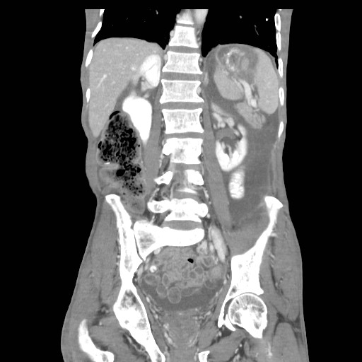 File:Acute pancreatitis (Radiopaedia 50213-55558 Coronal C+ portal venous phase 30).jpg