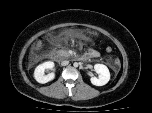 Acute pancreatitis (Radiopaedia 69236-79012 Axial C+ portal venous phase 40).jpg