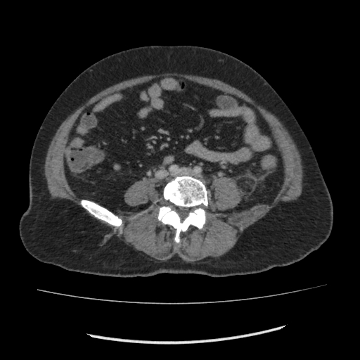Acute pancreatitis (Radiopaedia 80007-93285 Axial C+ portal venous phase 111).jpg