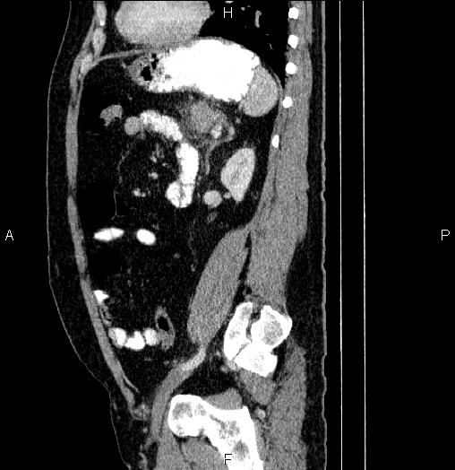 File:Acute pancreatitis (Radiopaedia 85390-101010 Sagittal C+ portal venous phase 70).jpg