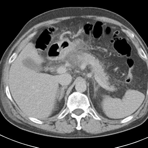 Acute pancreatitis and walled-off necrosis (Radiopaedia 29888-30403 Axial C+ delayed 25).jpg