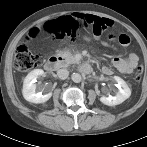 Acute pancreatitis and walled-off necrosis (Radiopaedia 29888-30403 Axial C+ delayed 38).jpg
