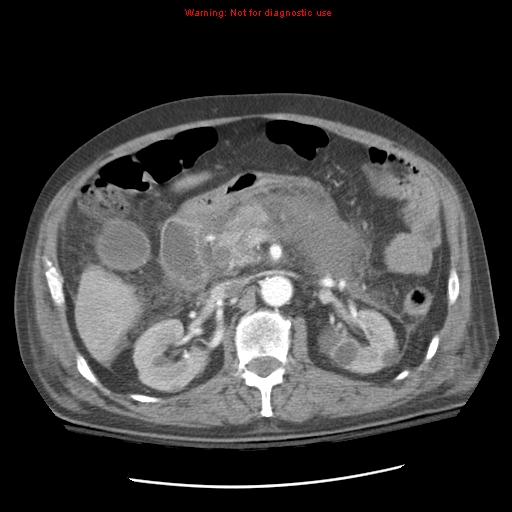 File:Acute pancreatitis with incidental pancreatic lipoma (Radiopaedia 10190-10730 Axial C+ arterial phase 41).jpg