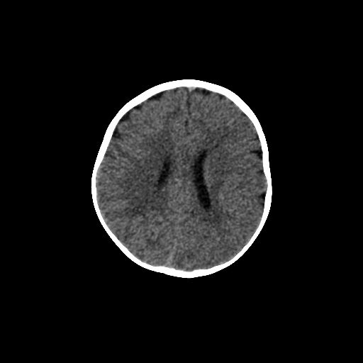 Acute phase of hemiconvulsion-hemiplegia epilepsy syndrome (Radiopaedia 29309-29744 Axial non-contrast 19).jpg