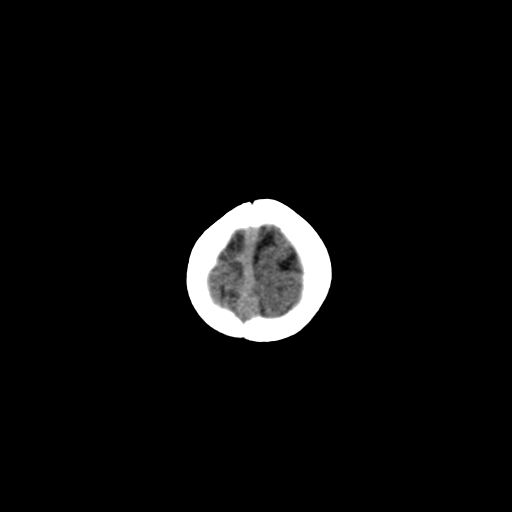 Acute phase of hemiconvulsion-hemiplegia epilepsy syndrome (Radiopaedia 29309-29744 Axial non-contrast 4).jpg