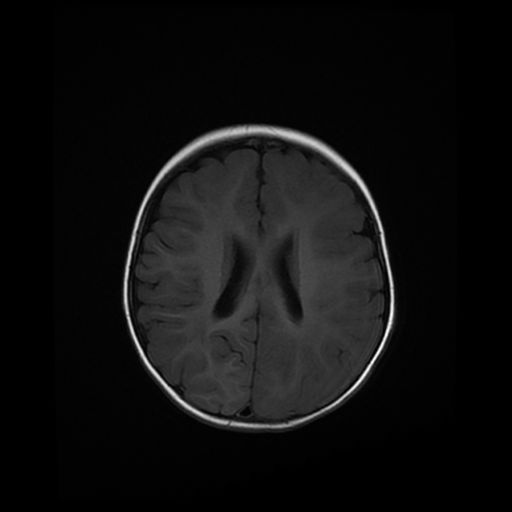File:Acute phase of hemiconvulsion-hemiplegia epilepsy syndrome (Radiopaedia 29309-29745 Axial T1 9).jpg