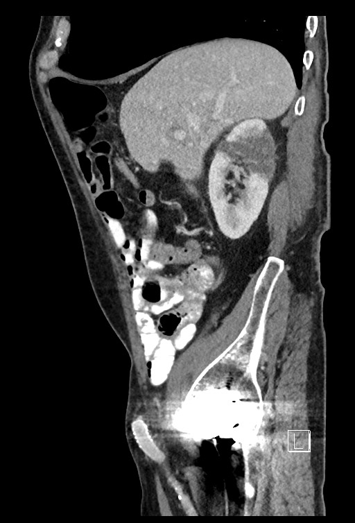 Acute renal infarction - rim capsular enhancement (Radiopaedia 59833-67270 Sagittal C+ portal venous phase 66).jpg