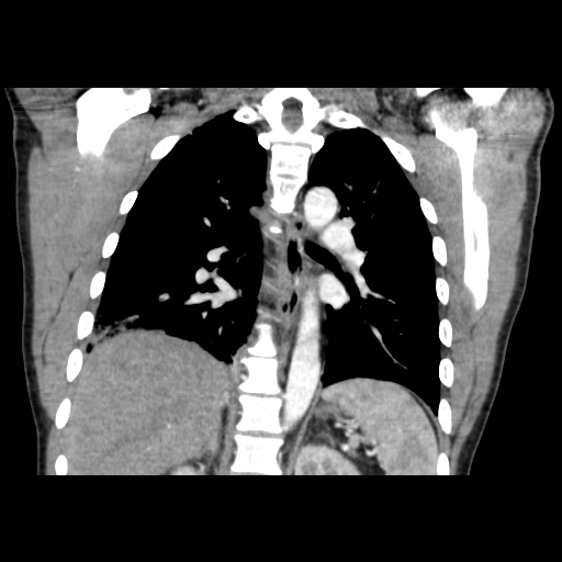 File:Acute segmental pulmonary emboli and pulmonary infarction (Radiopaedia 62264-70444 Coronal C+ CTPA 34).jpg