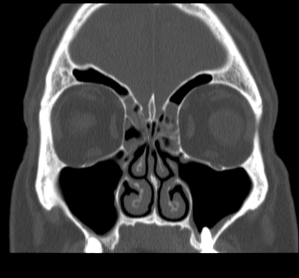 File:Acute sinusitis (Radiopaedia 23161-23215 Coronal bone window 31).jpg
