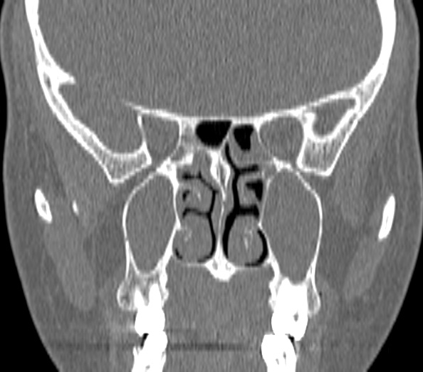 Acute sinusitis (Radiopaedia 40564-43158 Coronal bone window 28).jpg
