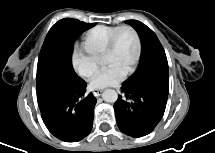 Acute small bowel (ileal) volvulus (Radiopaedia 71740-82139 Axial C+ portal venous phase 26).jpg