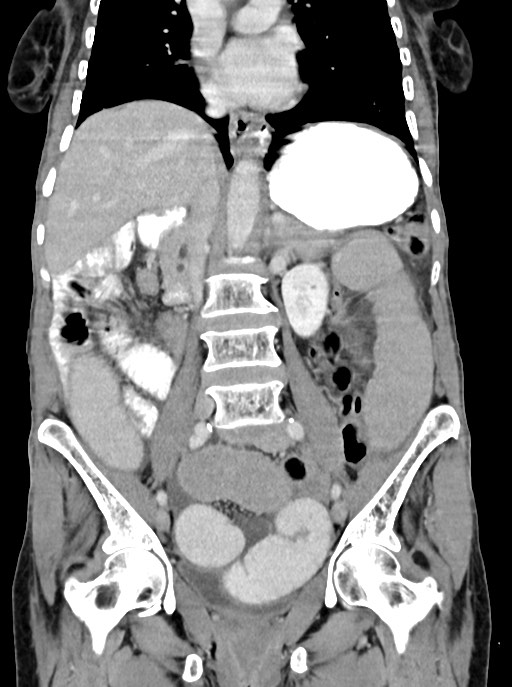 Acute small bowel (ileal) volvulus (Radiopaedia 71740-82139 Coronal C+ portal venous phase 61).jpg