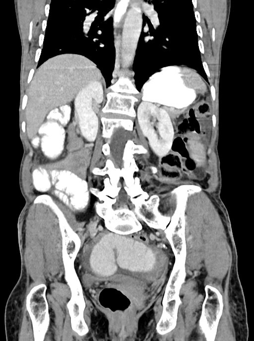 Acute small bowel (ileal) volvulus (Radiopaedia 71740-82139 Coronal C+ portal venous phase 76).jpg