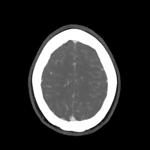 Acute subarachnoid hemorrhage and accessory anterior cerebral artery (Radiopaedia 69231-79009 D 57).jpg