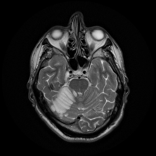 File:Acute superior cerebellar artery territory infarct (Radiopaedia 84104-99358 Axial T2 23).jpg