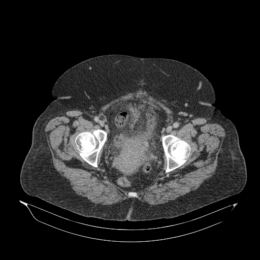 File:Acute superior mesenteric artery occlusion (Radiopaedia 51288-56960 Axial C+ portal venous phase 94).jpg