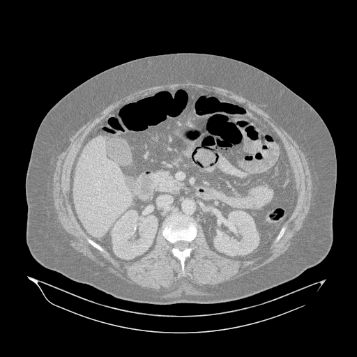 Acute superior mesenteric artery occlusion (Radiopaedia 51288-56960 Axial lung window 19).jpg