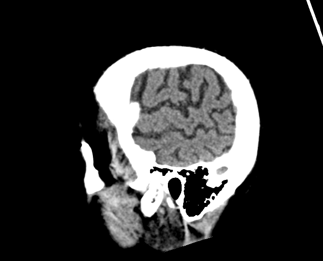 Acute traumatic subdural hematoma (Radiopaedia 82921-97257 Sagittal non-contrast 61).jpg