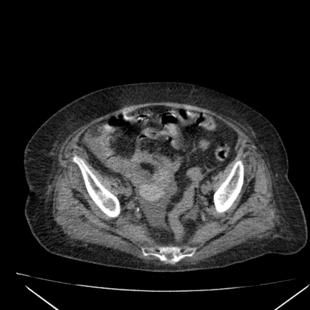 Acute tubular necrosis (Radiopaedia 28077-28334 Axial non-contrast 57).jpg