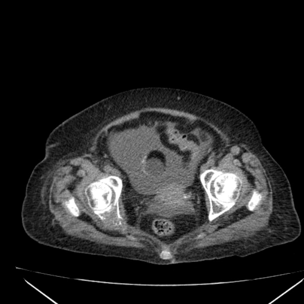 Acute tubular necrosis (Radiopaedia 28077-28334 F 63).jpg